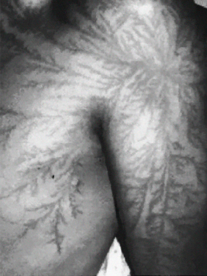 The Lichtenberg figures are the results of the lightning moving toward the surface of the body