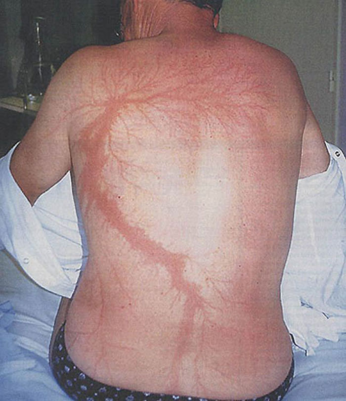 And although roughly 90% of those struck survive, the electrical discharge scars some of them with a tattoo-like mark