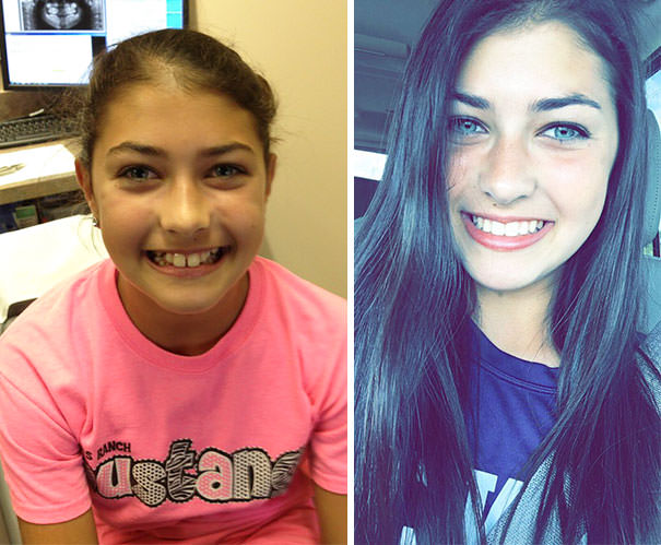 Thank you Jesus for braces!