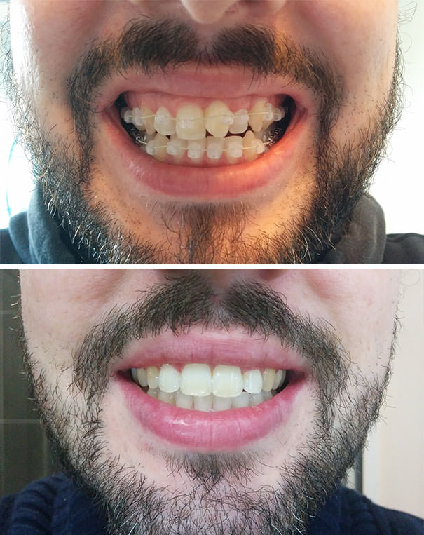 Before And After Braces Incredible Transformations Of People Who Wore 