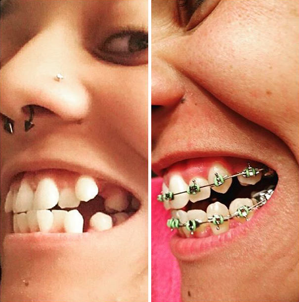 The day before i got braces vs. Month 8