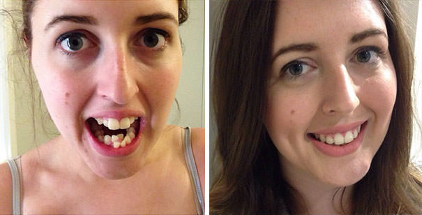 Before and after braces: Incredible Transformations of People Who Wore ...