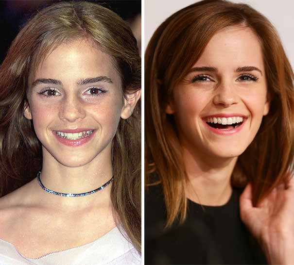 Emma Watson’s smile transformation