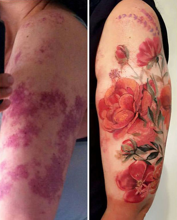 Tattoo covering an extensive port wine stain birthmark