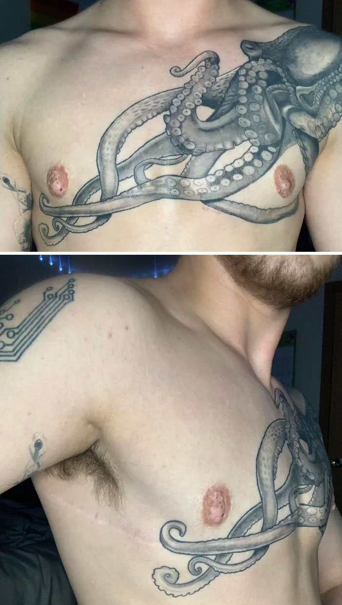 Tattoo scar cover-up 3 years post-op