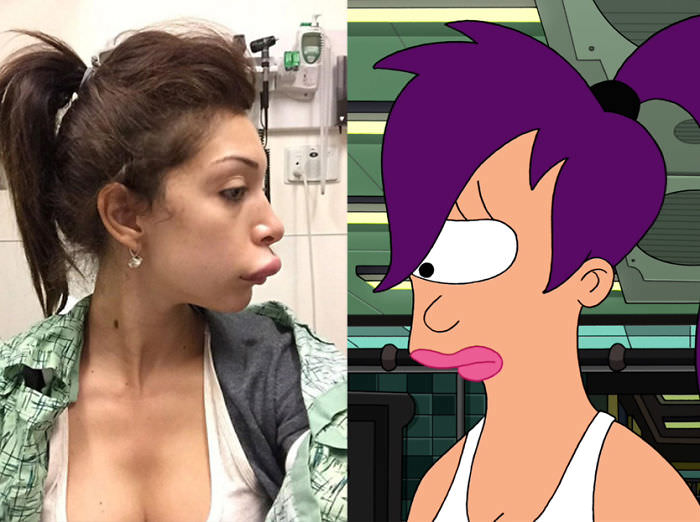 Girl after plastic surgery looks like Leela from Futurama