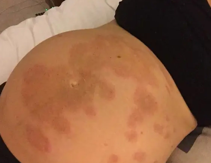 Rash life. Wanna know the kicker? I can’t take anything to prevent the itchiness. I’m surprised my partner stayed by my side after all of my complaining lol
