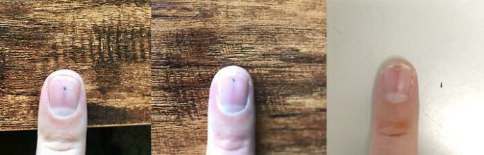 The thorn that’s been traveling through my fingernail since July 18 completed its journey in October.