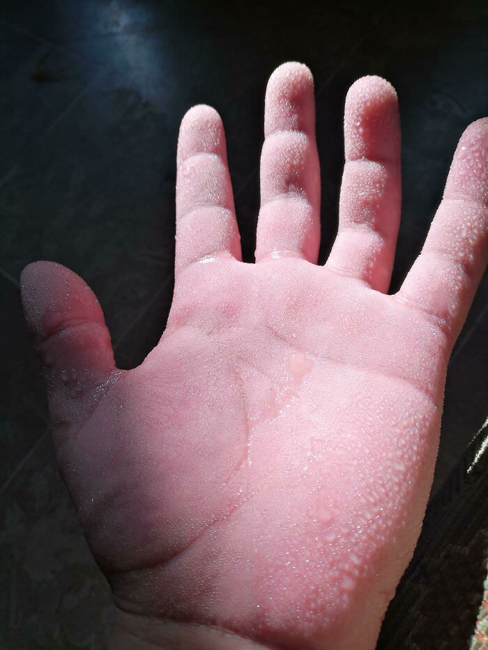 I have hyperhidrosis, which means my hands and feet sweat a lot. This is how my hands usually look.