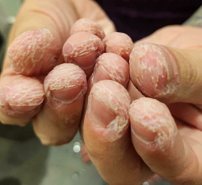 What my fingers look like when I get out of the bath after years of biting them.