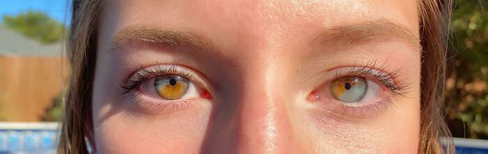 I have partial heterochromia in both eyes.